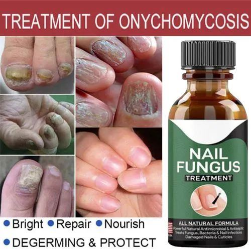 Fast Nail Fungal Treatment Gel – Repair & Care for Healthy Nails